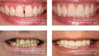 Triad Dentistry | Dental Implants Greensboro NC image 4